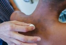 Em 2025, Paraíba registra 15 casos de Hanseníase em crianças e adolescentes