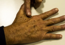 Casos de câncer de pele crescem 72% em dez anos no Brasil